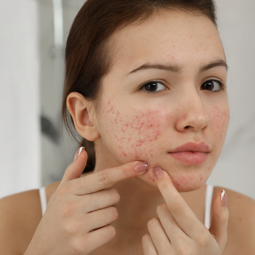 Acne Treatment Set